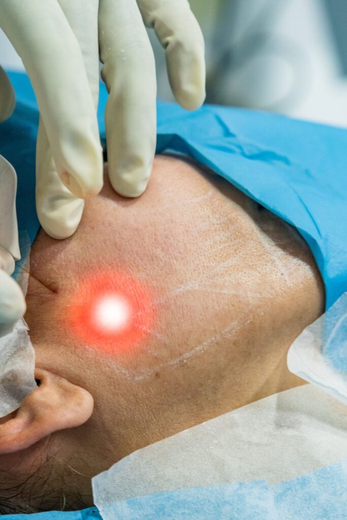 Tratamiento de endolifting facial con tecnología láser para tensar la piel y estimular la producción de colágeno.

Procedimiento de endoláser para reducción de grasa localizada y remodelación corporal sin cirugía.